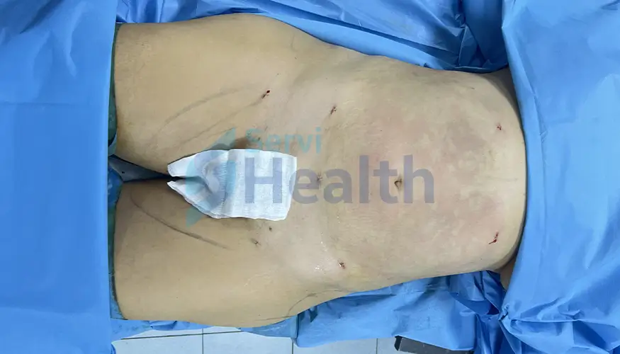 photo après liposuccion en tunisie