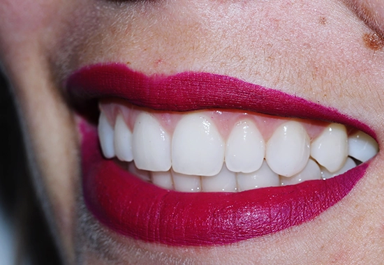 Suivi et entretien de vos facettes