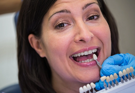 Qu’est-ce qu’une facette dentaire ?